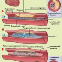 Стентирование коронарных сосудов